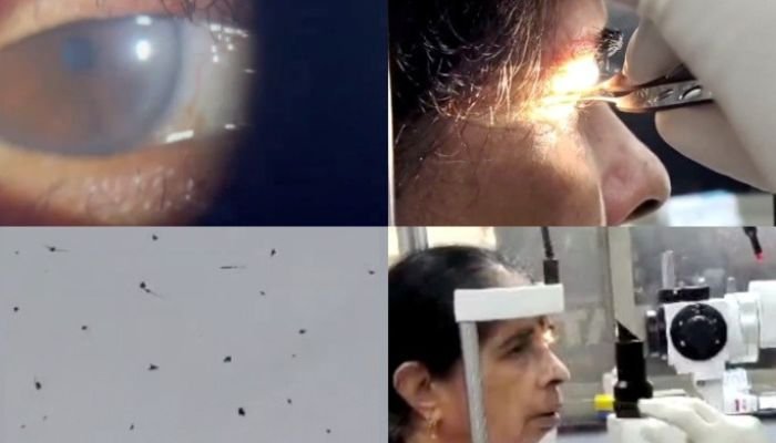 குஜராத்தில் மூதாட்டியின் கண் இமைகளில் 250 பேன்கள்; மருத்துவர்கள் அதிர்ச்சி