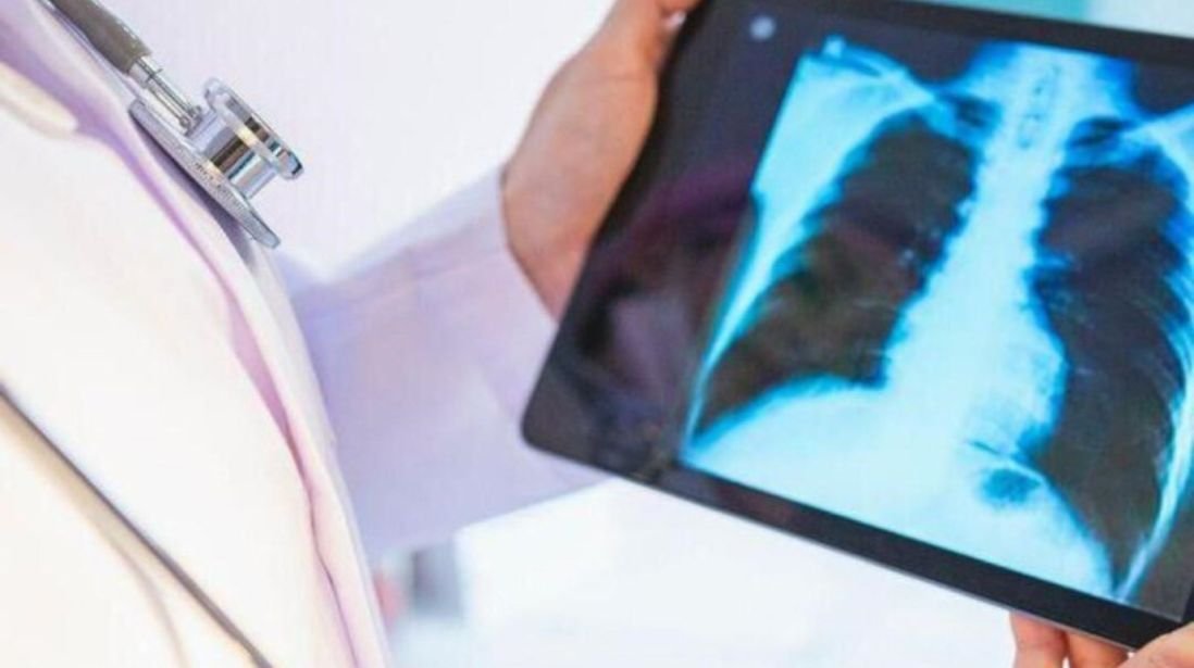 இவ்வாண்டு மலேசியாவில் 3,161 காசநோய் சம்பவங்கள்; 596 புதியத் தொற்றுகள்